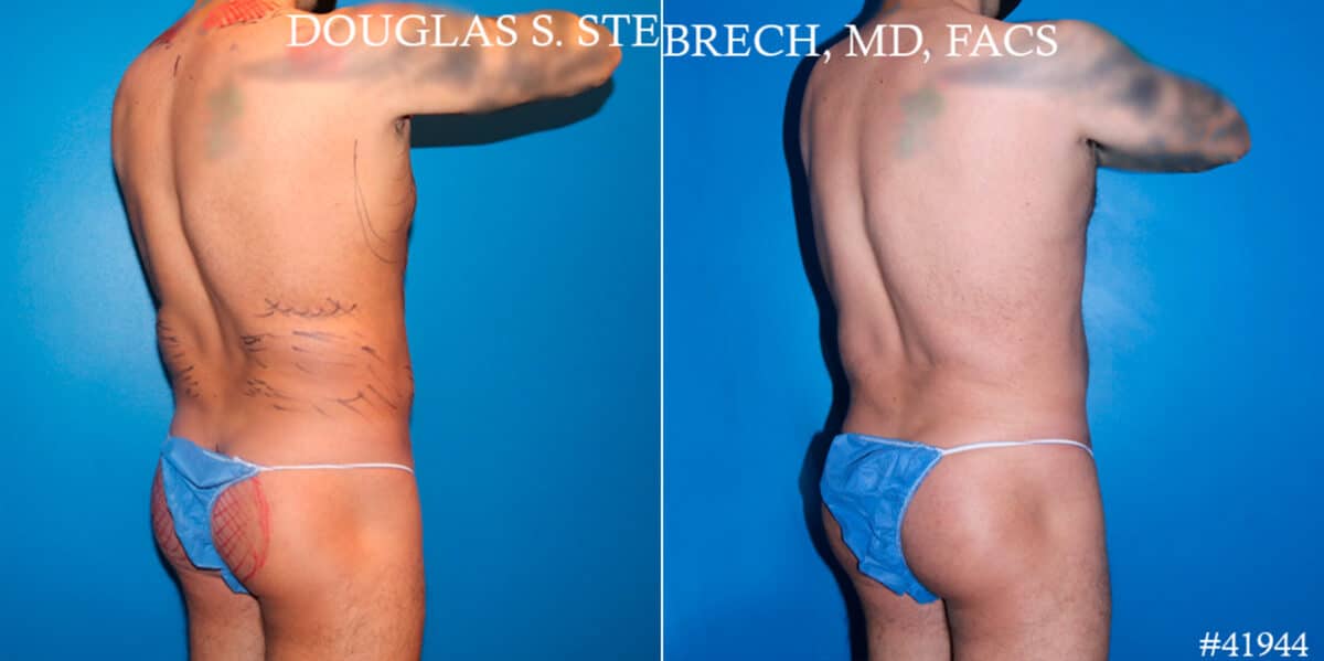 Body Banking Before and After Photos in CA, Beverly Hills, Patient 17802