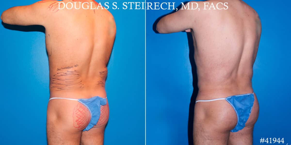 Body Banking Before and After Photos in CA, Beverly Hills, Patient 17802