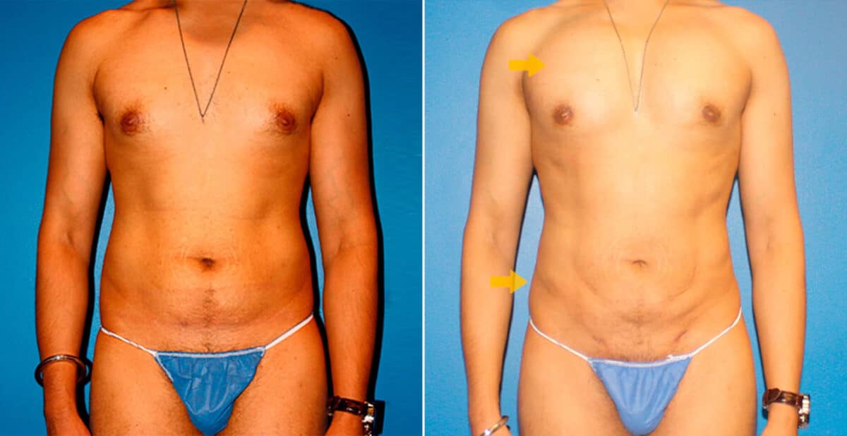 Body Banking Before and After Photos in New York, NY, Patient 16731