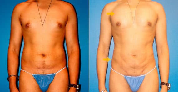 Body Banking Before and After Photos in New York, NY, Patient 16731