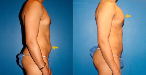 Body Banking Before and After Photos in New York, NY, Patient 16731