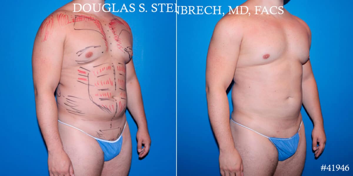 Body Banking Before and After Photos in CA, Beverly Hills, Patient 17843