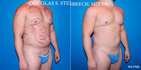 Body Banking Before and After Photos in CA, Beverly Hills, Patient 17843