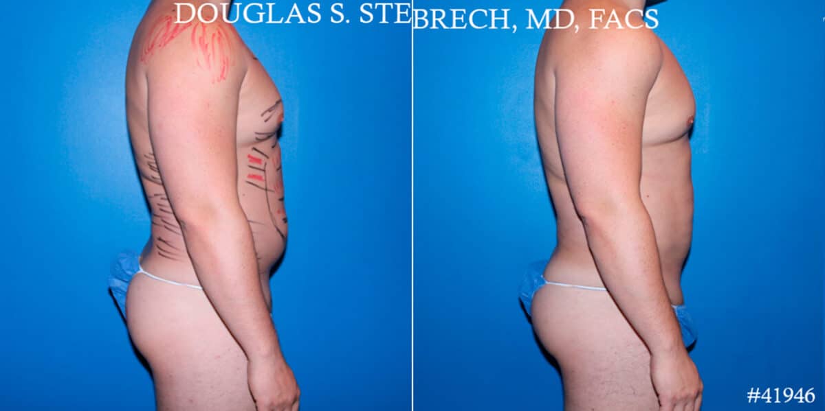 Body Banking Before and After Photos in CA, Beverly Hills, Patient 17843