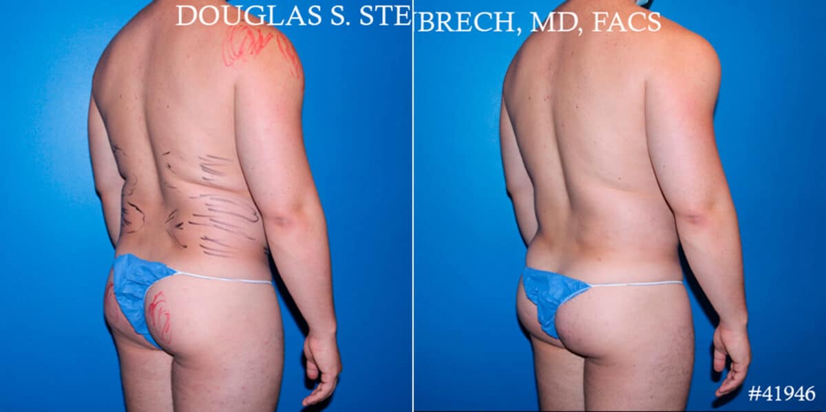 Body Banking Before and After Photos in CA, Beverly Hills, Patient 17843