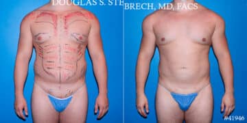 Body Banking Before and After Photos in CA, Beverly Hills, Patient 17843