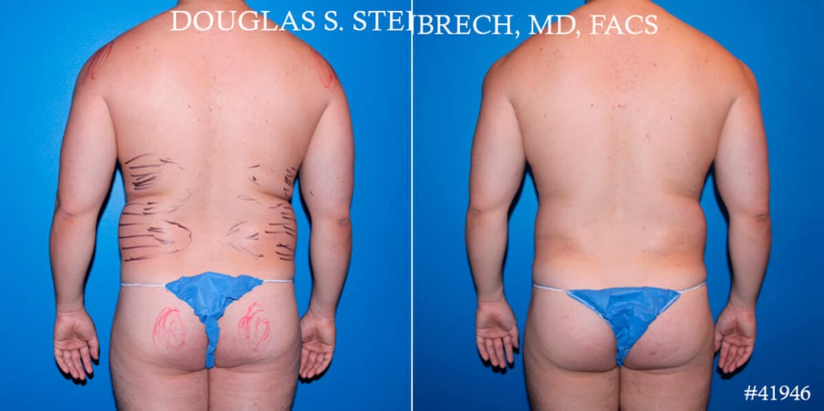 Body Banking Before and After Photos in CA, Beverly Hills, Patient 17843