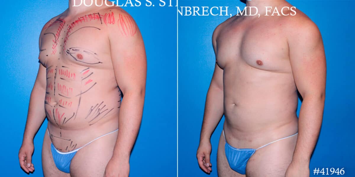 Body Banking Before and After Photos in CA, Beverly Hills, Patient 17843