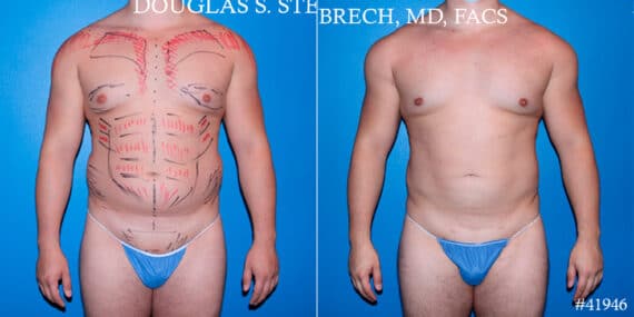 Body Banking Before and After Photos in CA, Beverly Hills, Patient 17843
