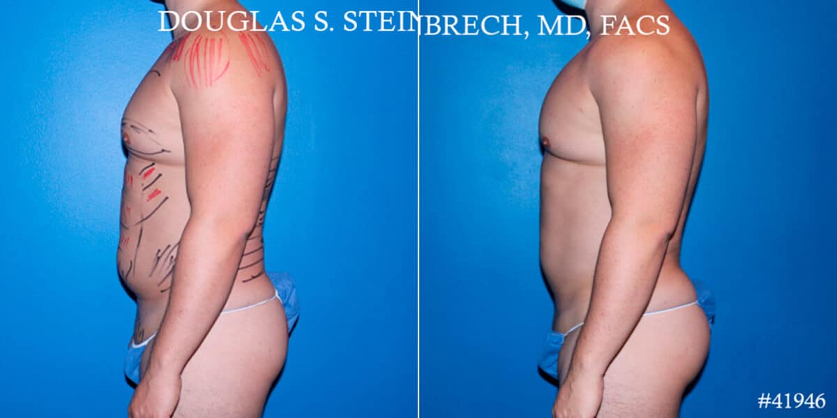 Body Banking Before and After Photos in CA, Beverly Hills, Patient 17843