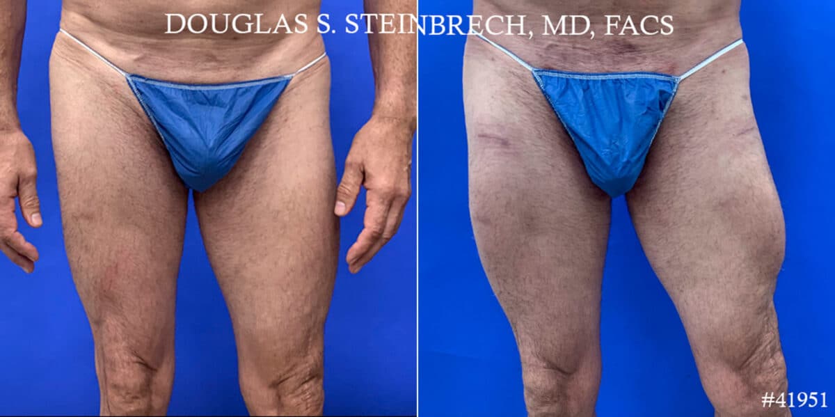 Calf Implants Before and After Photos in CA, Beverly Hills, Patient 17865