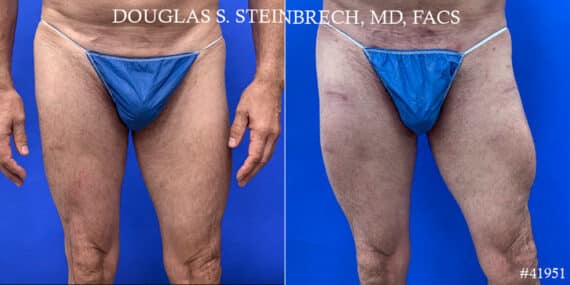 Calf Implants Before and After Photos in CA, Beverly Hills, Patient 17865