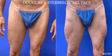 Calf Implants Before and After Photos in CA, Beverly Hills, Patient 17865