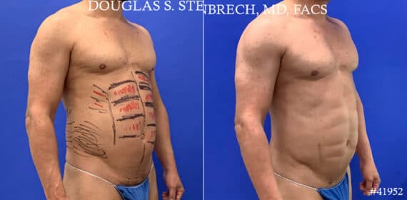 Body Banking Before and After Photos in CA, Beverly Hills, Patient 17872