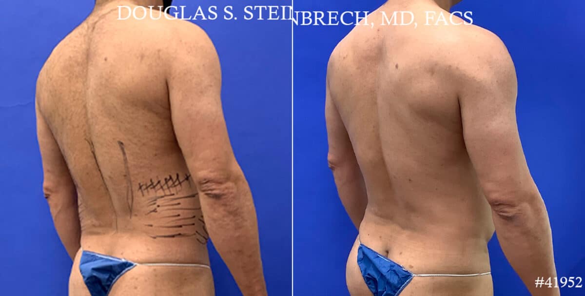 Body Banking Before and After Photos in CA, Beverly Hills, Patient 17872