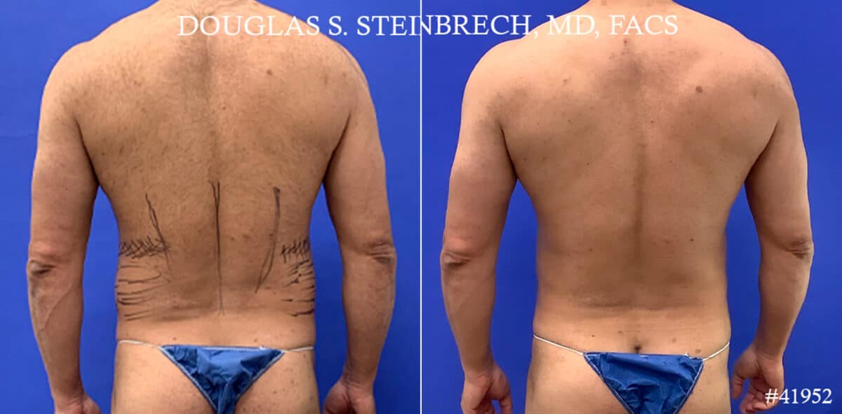 Body Banking Before and After Photos in CA, Beverly Hills, Patient 17872