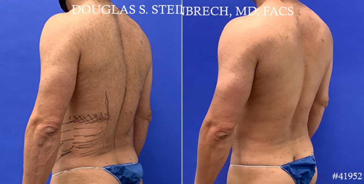 Body Banking Before and After Photos in CA, Beverly Hills, Patient 17872