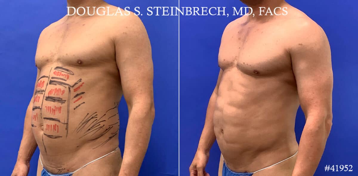 Body Banking Before and After Photos in CA, Beverly Hills, Patient 17872