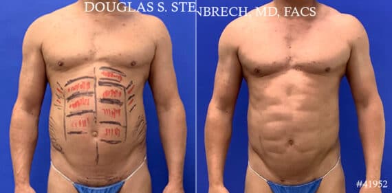 Body Banking Before and After Photos in CA, Beverly Hills, Patient 17872