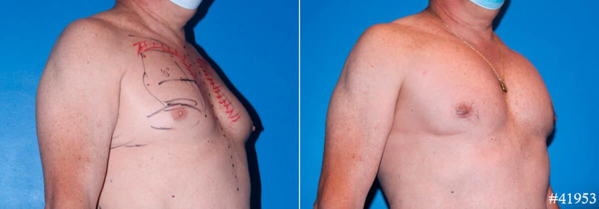 Pectoral Augmentation Before and After Photos in CA, Beverly Hills, Patient 17891