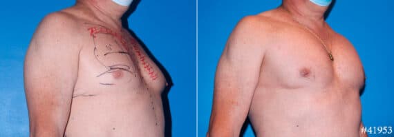 Pectoral Augmentation Before and After Photos in CA, Beverly Hills, Patient 17891