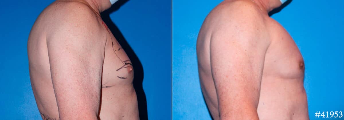 Pectoral Augmentation Before and After Photos in CA, Beverly Hills, Patient 17891