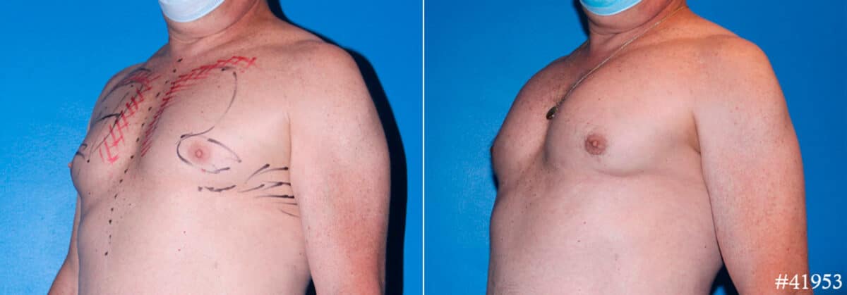 Pectoral Augmentation Before and After Photos in CA, Beverly Hills, Patient 17891