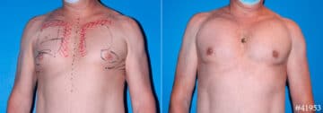 Pectoral Augmentation Before and After Photos in CA, Beverly Hills, Patient 17891