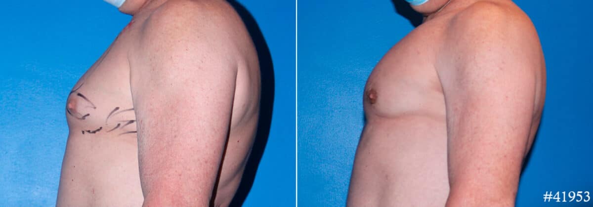 Pectoral Augmentation Before and After Photos in CA, Beverly Hills, Patient 17891