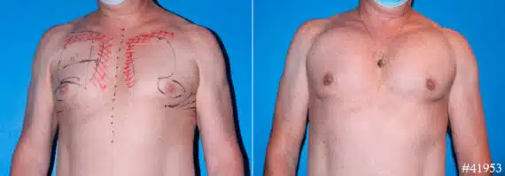 Pectoral Augmentation Before and After Photos in CA, Beverly Hills, Patient 17891