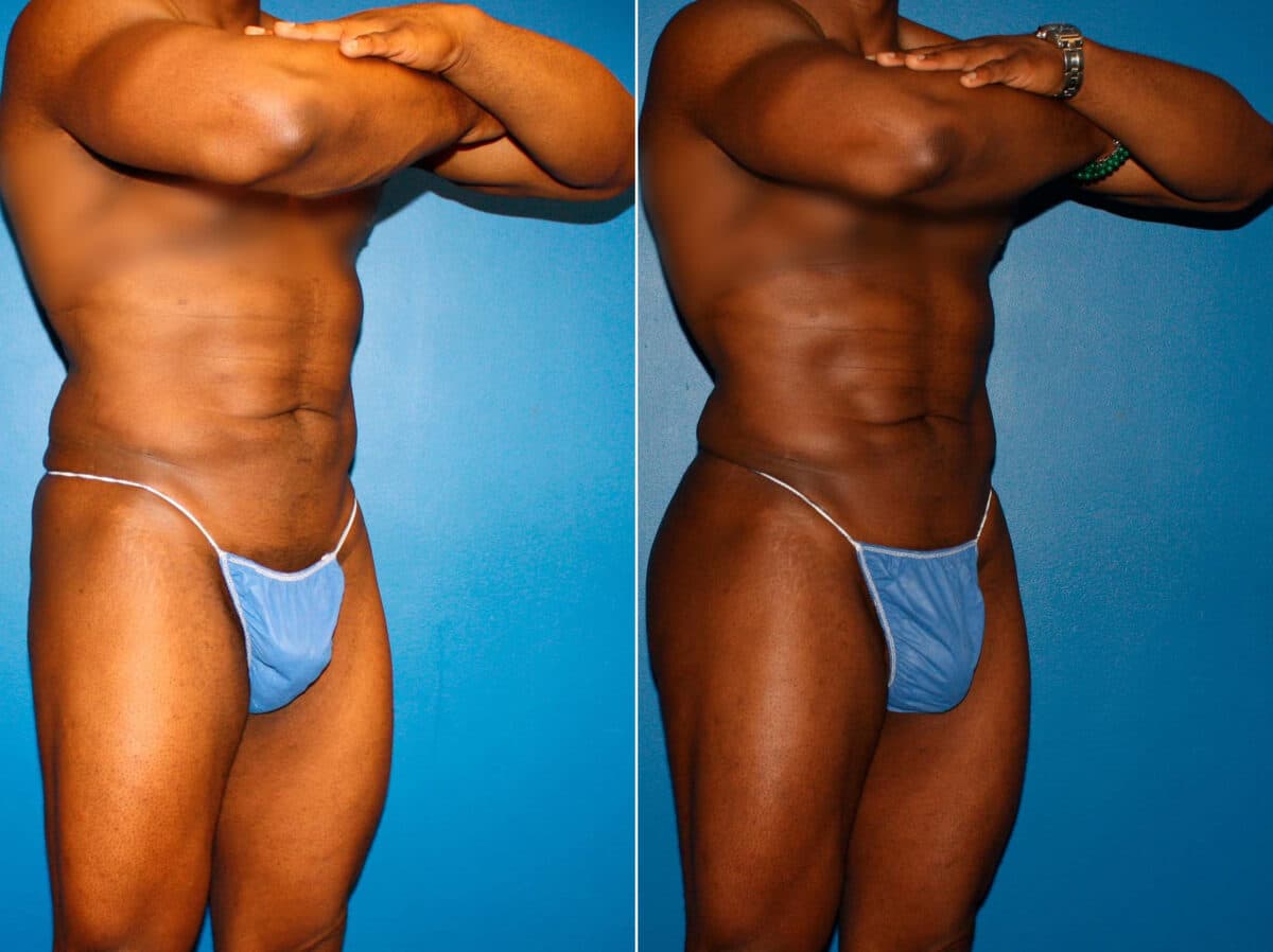 Gluteal Augmentation Before and After Photos in New York, NY, Patient 14502