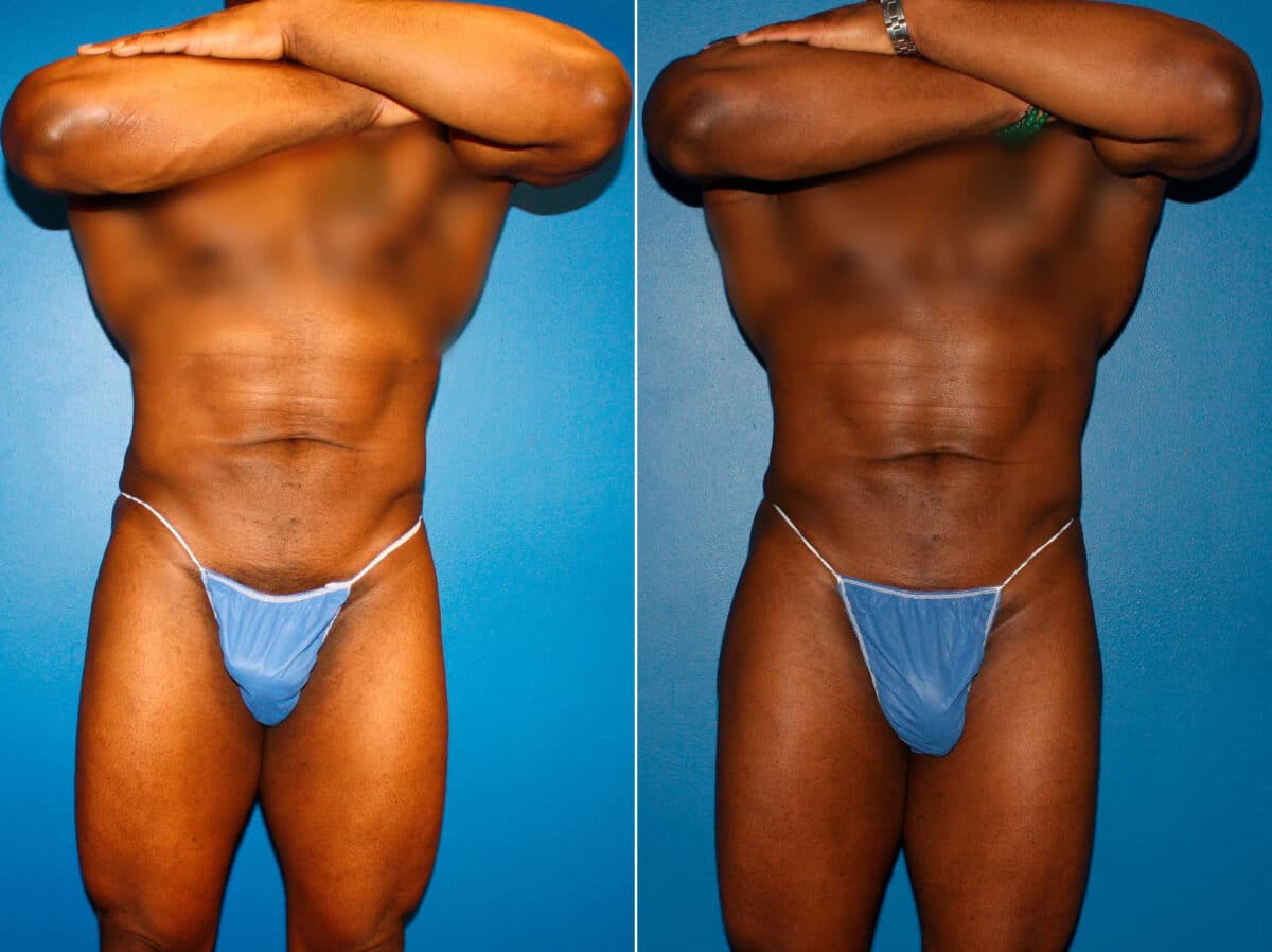 Gluteal Augmentation Before and After Photos in New York, NY, Patient 14502