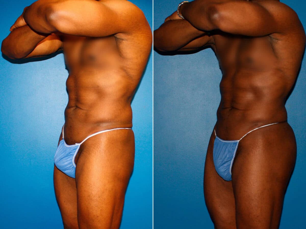 Gluteal Augmentation Before and After Photos in New York, NY, Patient 14502