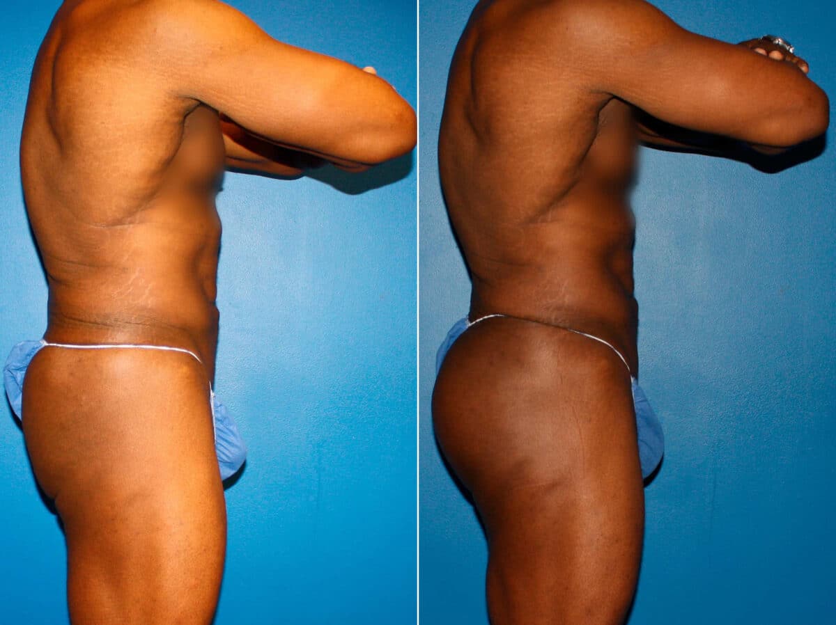 Gluteal Augmentation Before and After Photos in New York, NY, Patient 14502