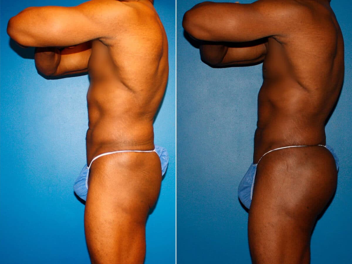 Gluteal Augmentation Before and After Photos in New York, NY, Patient 14502