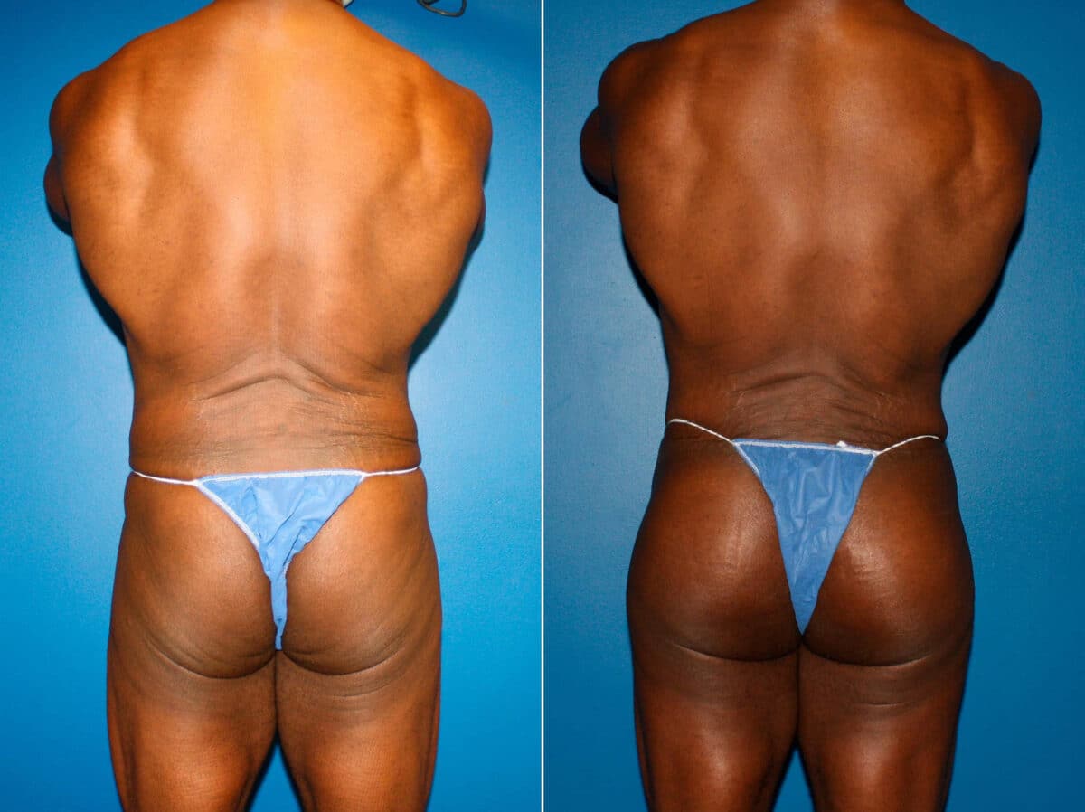 Gluteal Augmentation Before and After Photos in New York, NY, Patient 14502