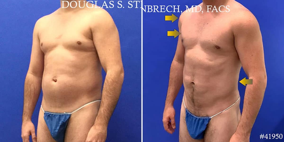 Body Banking Before and After Photos in CA, Beverly Hills, Patient 17786