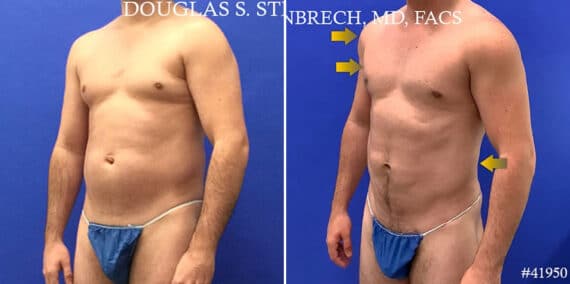Body Banking Before and After Photos in CA, Beverly Hills, Patient 17786