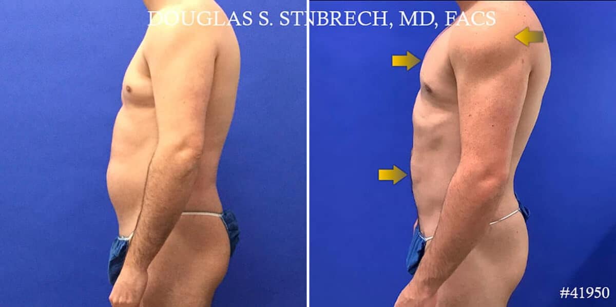 Body Banking Before and After Photos in CA, Beverly Hills, Patient 17786