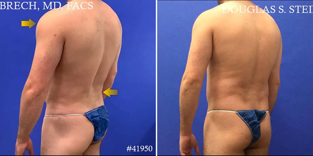 Body Banking Before and After Photos in CA, Beverly Hills, Patient 17786