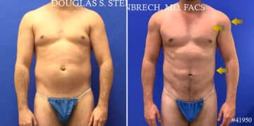 Body Banking Before and After Photos in CA, Beverly Hills, Patient 17786
