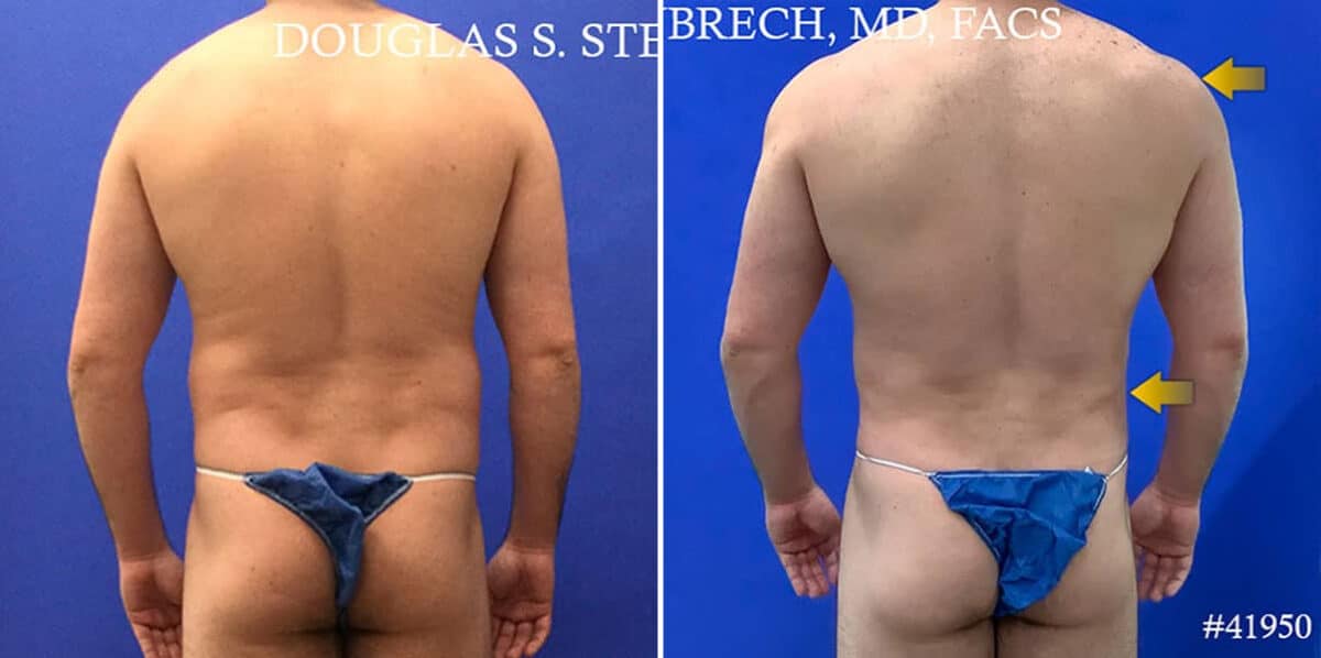 Body Banking Before and After Photos in CA, Beverly Hills, Patient 17786