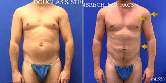 Body Banking Before and After Photos in CA, Beverly Hills, Patient 17786