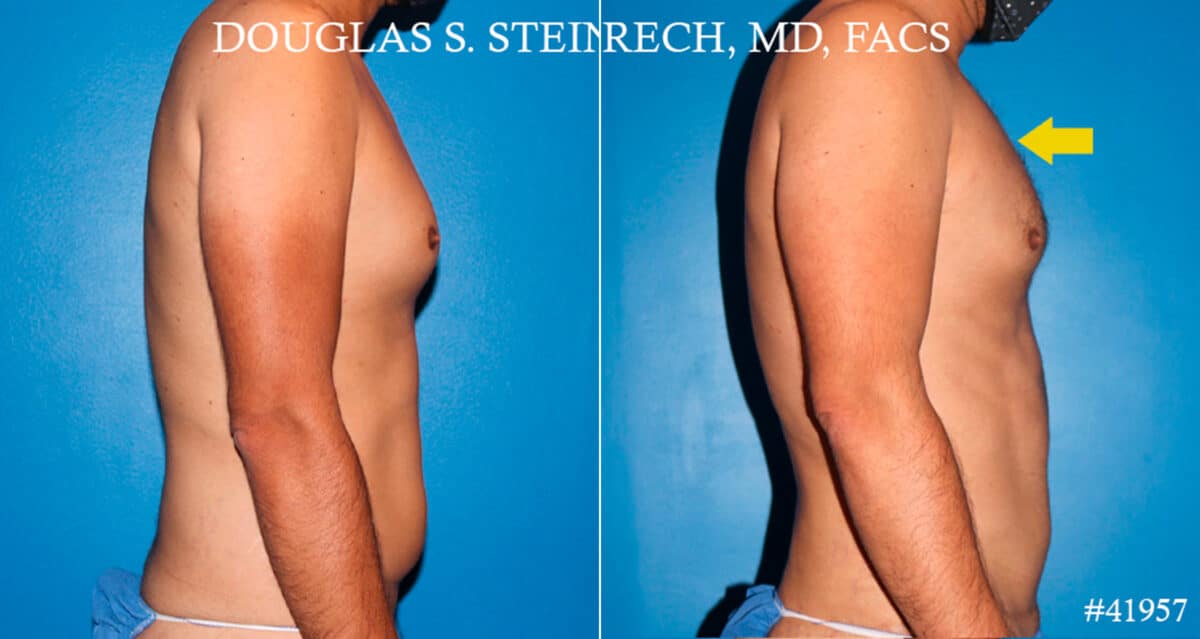 Body Banking Before and After Photos in New York, NY, Patient 18181