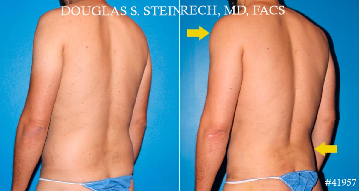 Body Banking Before and After Photos in New York, NY, Patient 18181