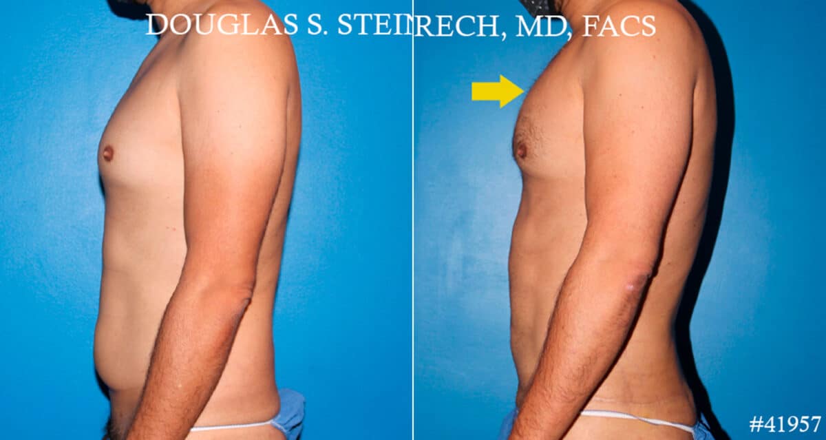 Body Banking Before and After Photos in New York, NY, Patient 18181