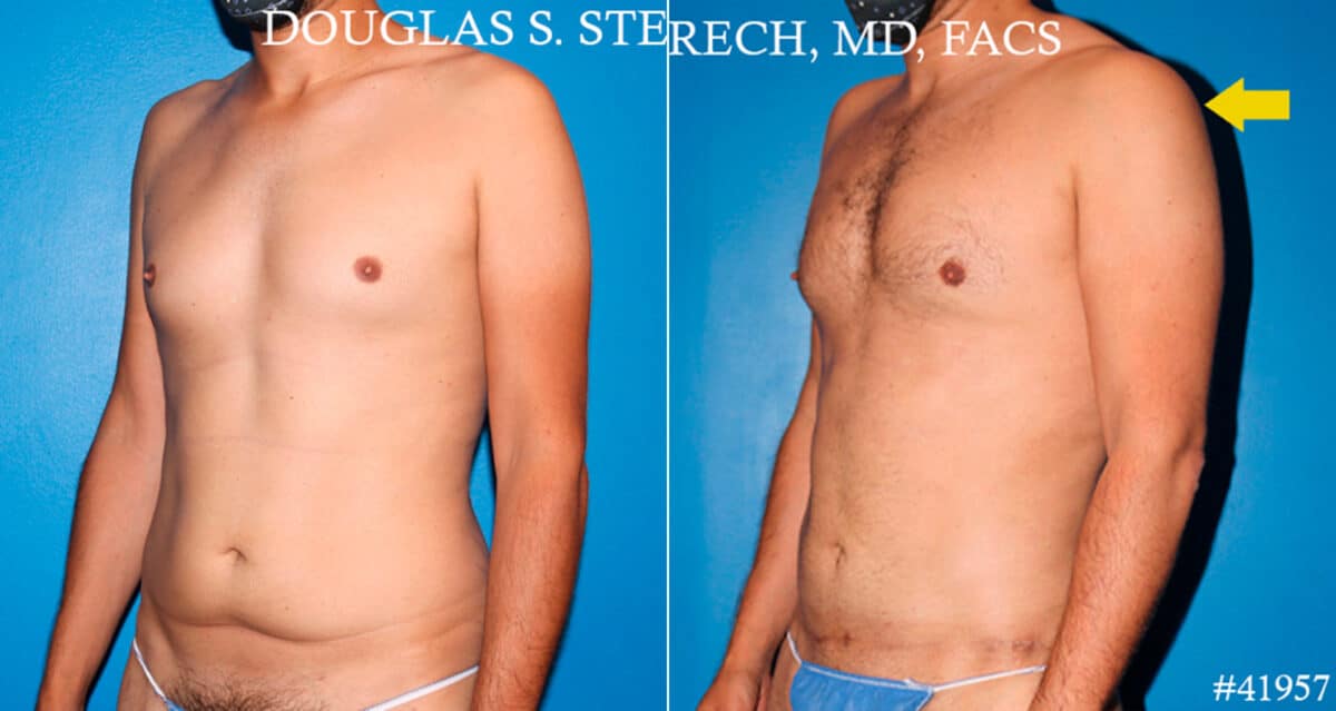 Body Banking Before and After Photos in New York, NY, Patient 18181