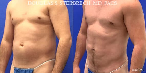 Gynecomastia Before and After Photos in New York, NY, Patient 18099