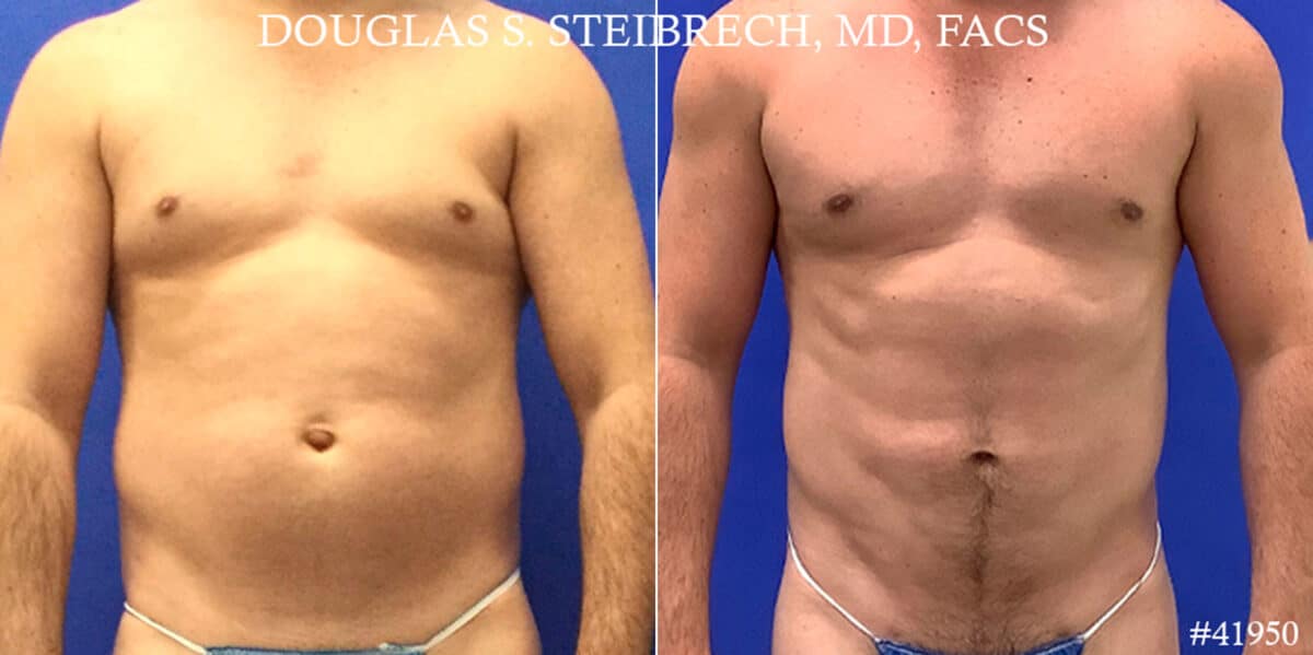 Gynecomastia Before and After Photos in New York, NY, Patient 18099