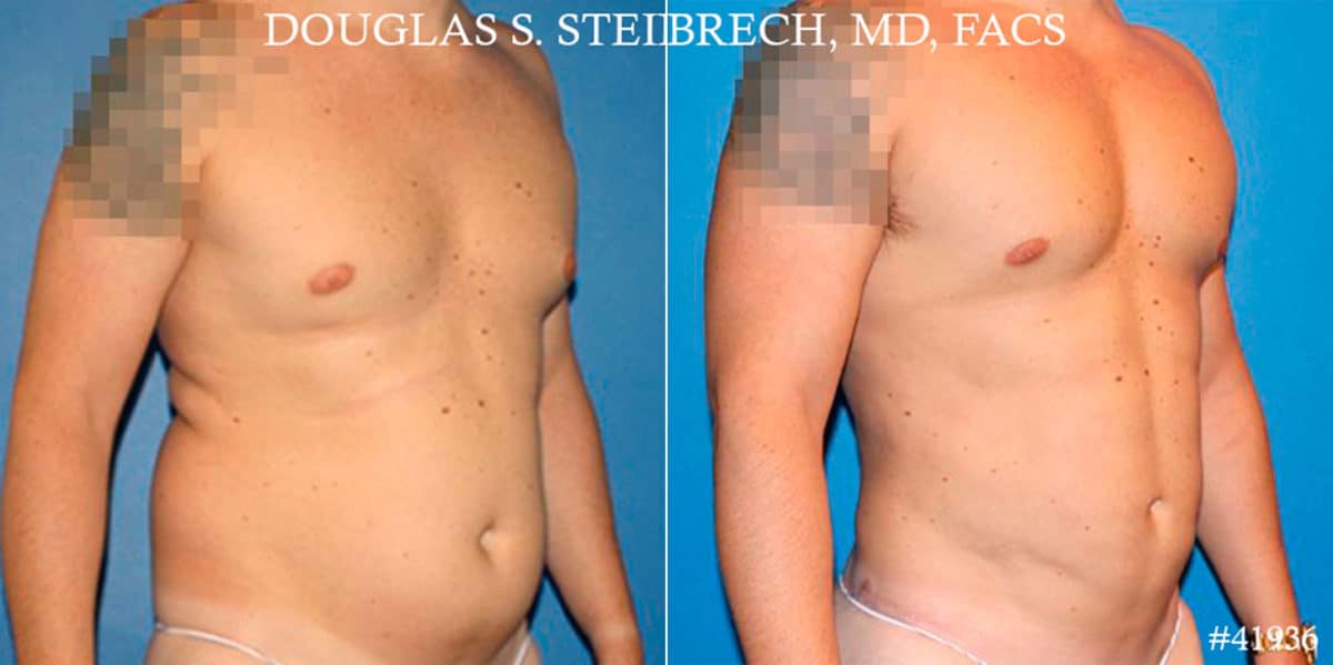 Gynecomastia Before and After Photos in CA, Beverly Hills, Patient 18106